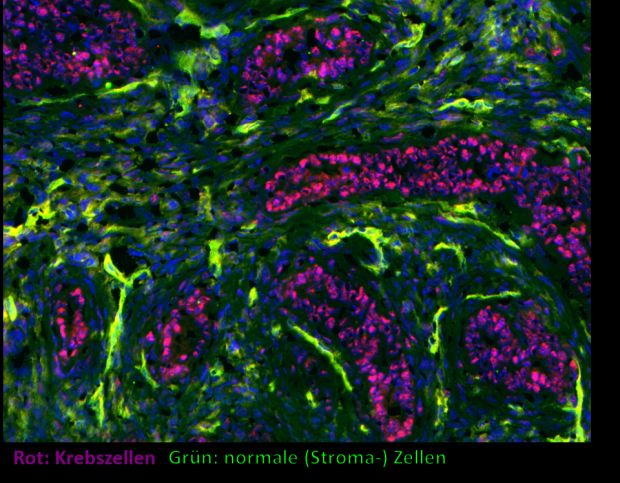 Krebs besteht nicht nur aus Krebszellen (rot), sondern auch aus Stromazellen einschließlich Immunzellen (grün). (Foto: Blankenstein Lab, MDC)