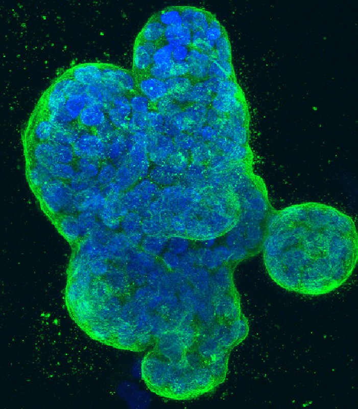 Dreidimensionale Kultur menschlicher Brustkrebszellen, mit blau gefärbter DNA und einem grün gefärbten Protein in der Zelloberflächenmembran (© NCI Center for Cancer Research, National Cancer Institute, National Institutes of Health)
