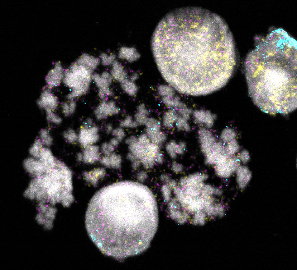 Kerne und Chromosomen von Neuroblastomzellen. DNA-Ringe sind gelb, türkis oder magenta angefärbt. Jede Farbe signalisiert unterschiedliche Krebsgene © Charité | Rocío Chamorro González