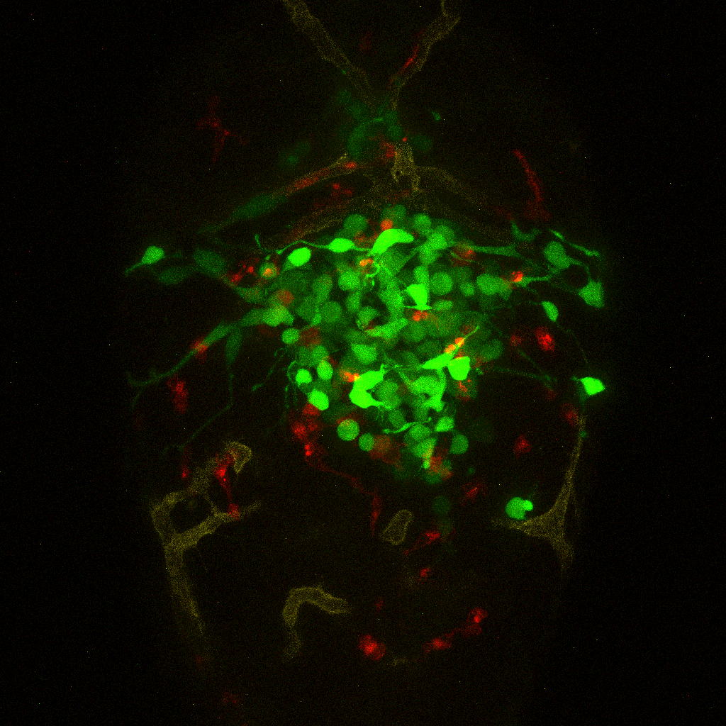 Gehirnregion eines Zebrafisch-Avatars, in dem ein menschliches Glioblastom wächst: Die Tumorzellen von Patient*innen sind grün markiert, das Netzwerk der Blutgefäße gelb und die Makrophagen (Immunzellen) rot (Bild: Lise Finotto, VIB – KU Leuven)