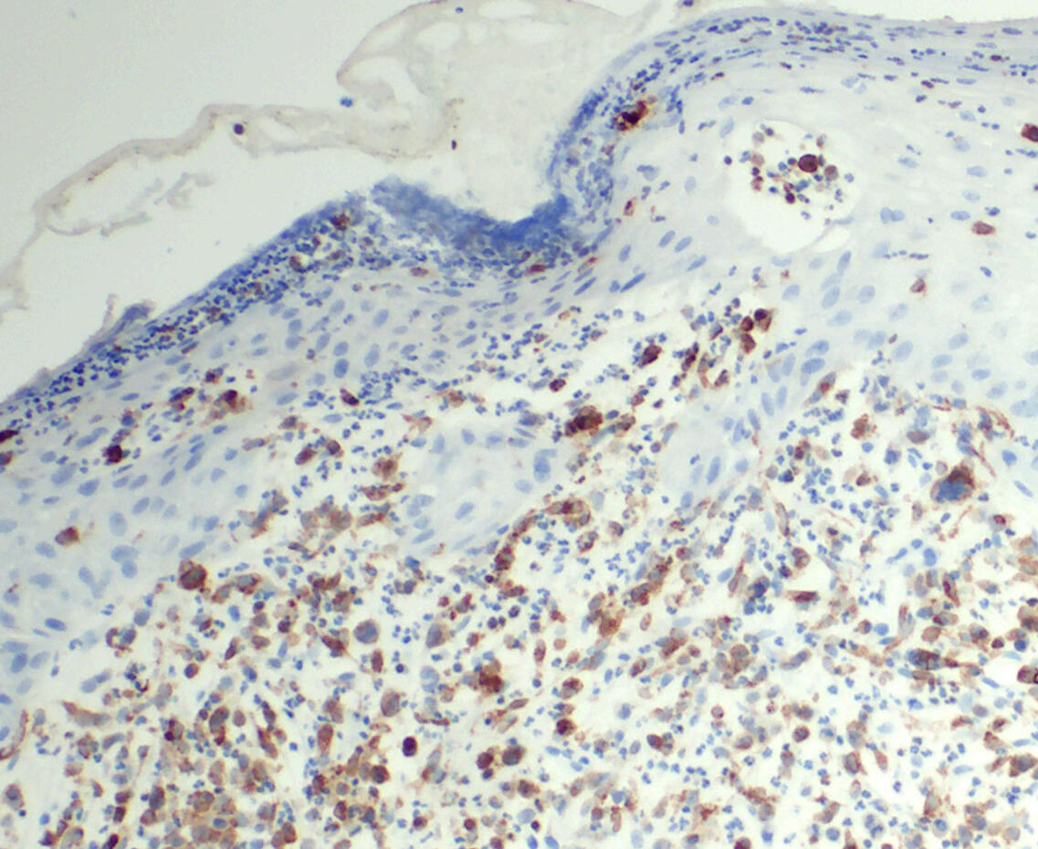 Kutanes T-Zell-Lymphom mit entarteten T-Zellen (markiert für CD74; braun) und gesunden Hautzellen (blau). © Charité | Ann-Christin von Brünneck